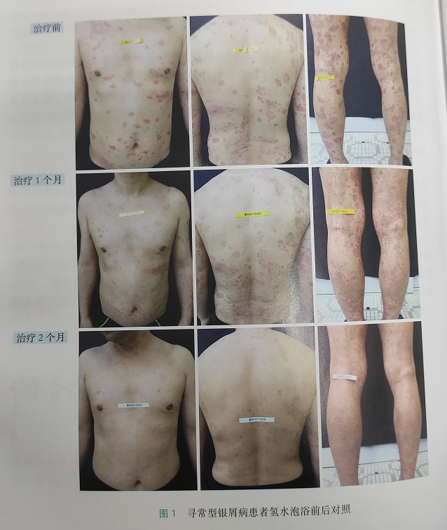 富氢片|富氢球|富氢材料应用方案